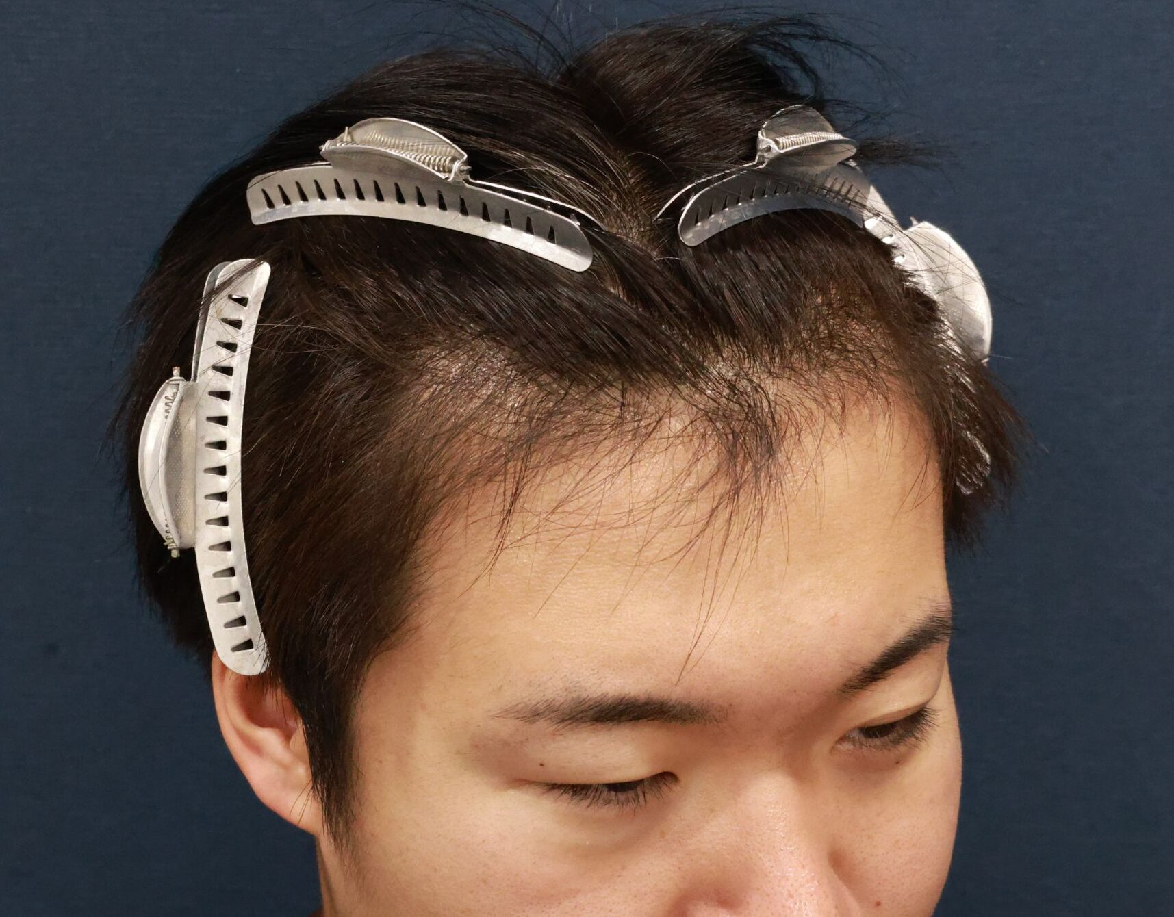 施術前