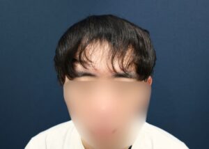 施術前