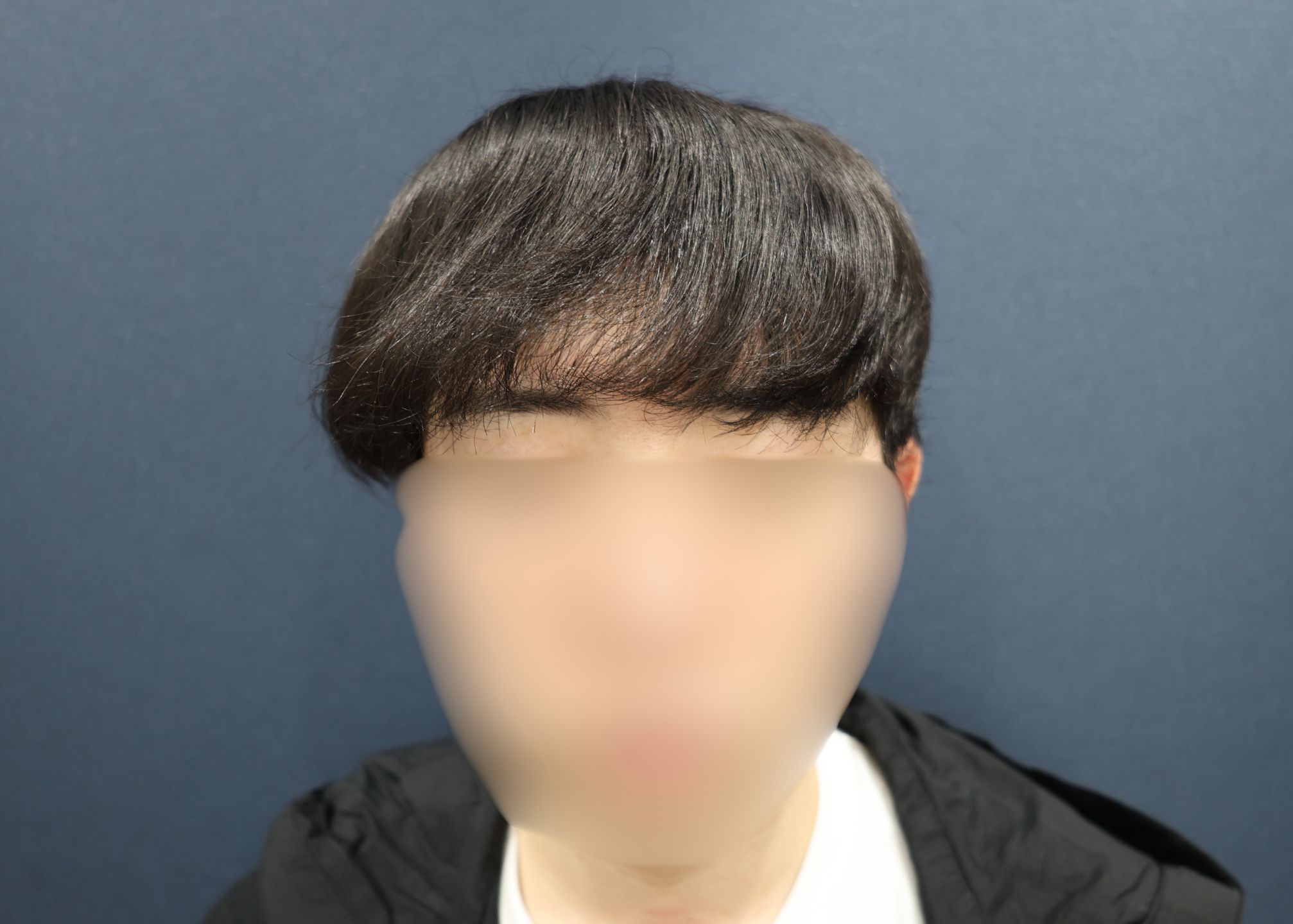 施術後6ヶ月
