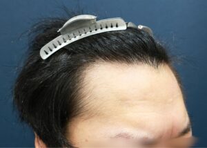 施術前