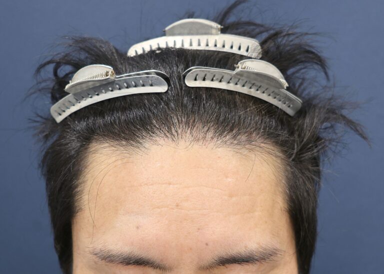症例写真