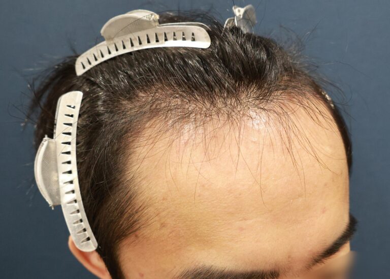 症例写真