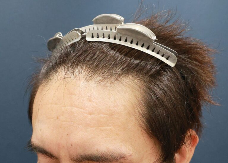 症例写真