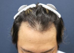 施術後6ヶ月