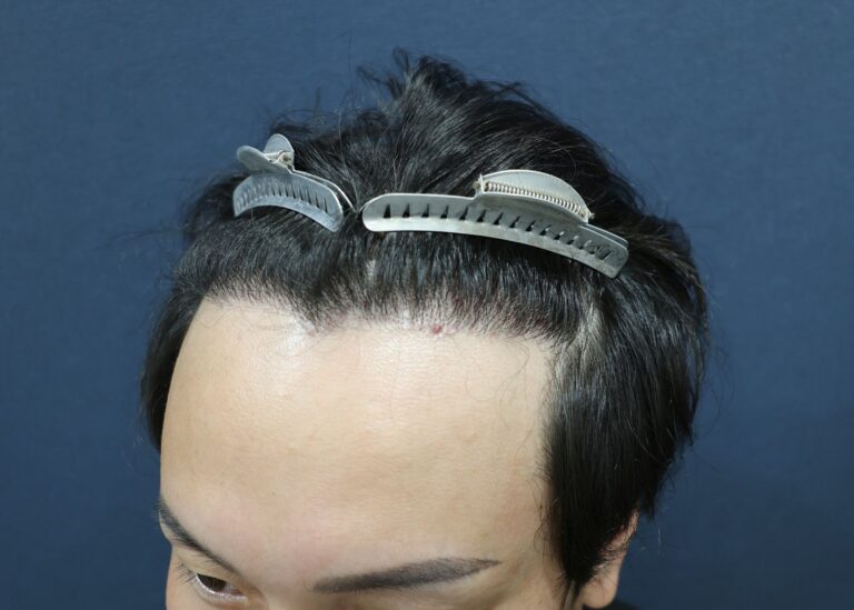 症例写真