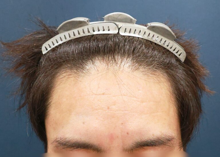 症例写真