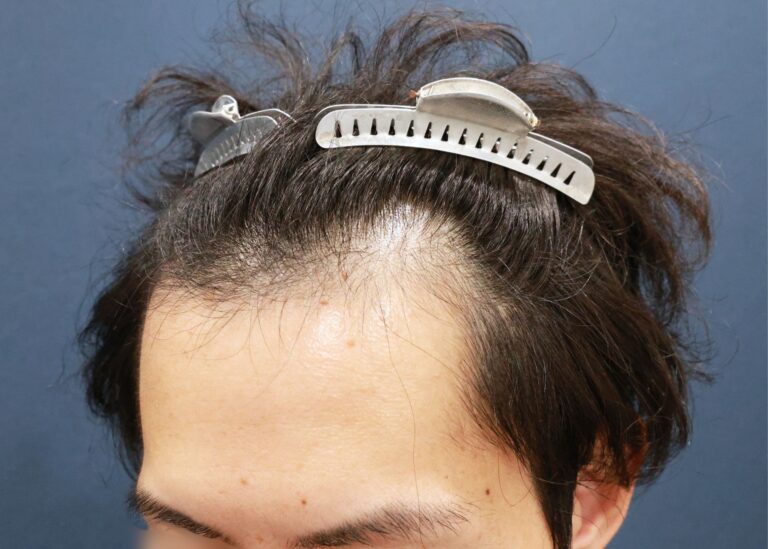 症例写真