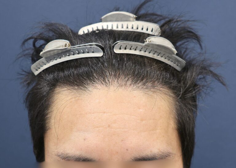 症例写真