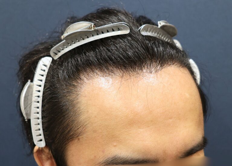 症例写真