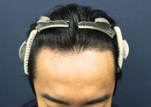 施術後7か月