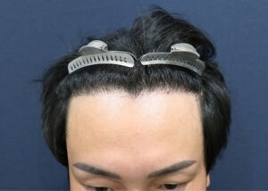 施術後6ヶ月