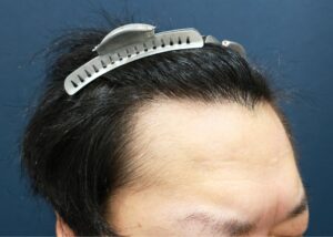 施術前