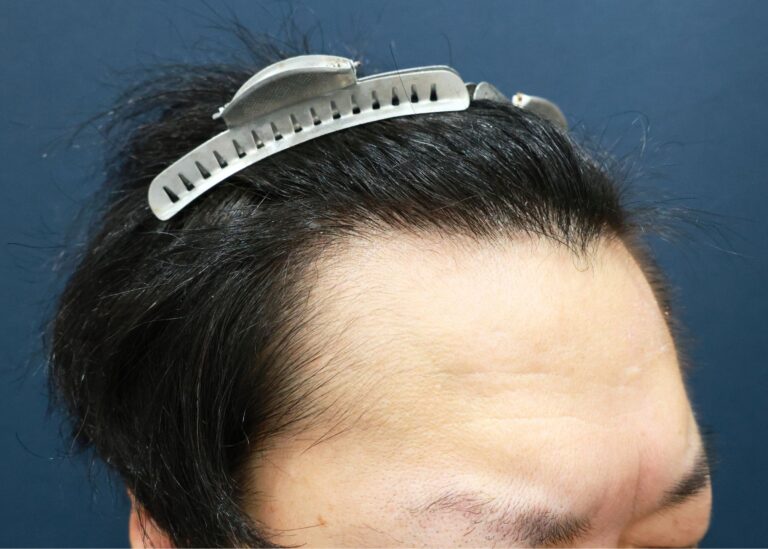症例写真