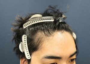施術前