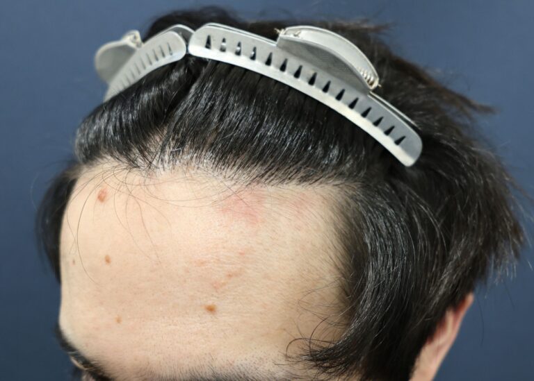 症例写真