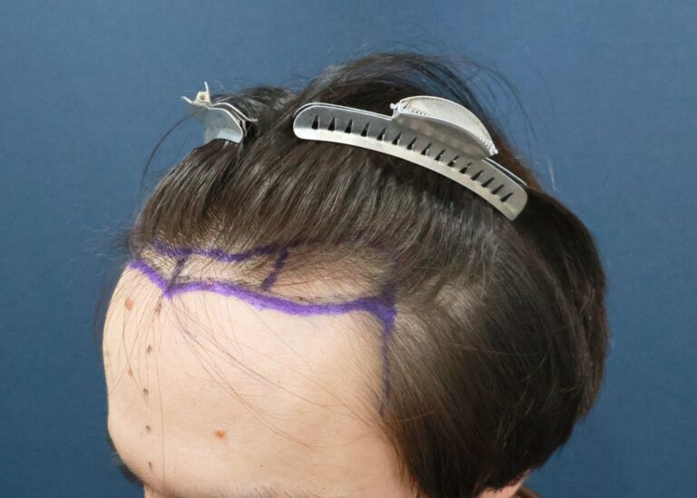 症例写真