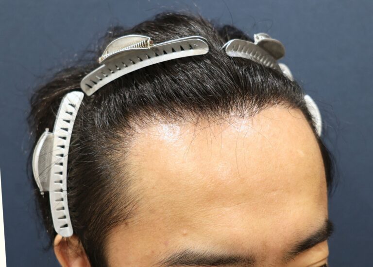 症例写真