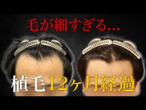 【40代薄毛】毛が細いと失敗する！？生え際のM字部分に植毛して12ヶ月後