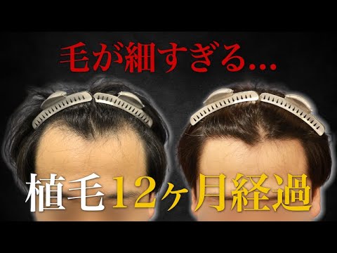 【40代薄毛】毛が細いと失敗する！？生え際のM字部分に植毛して12ヶ月後