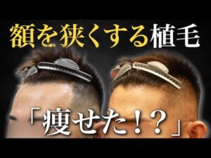 【自毛植毛】広くなったおでこを狭くしたい…30代男性の施術12ヶ月後