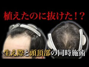 【30代薄毛】生え際と頭頂部に植毛して1年経過。ショックロスを最低限に抑えるためには…。