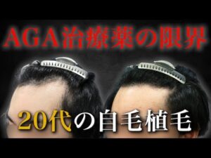 【20代植毛】AGA治療薬を内服するも、どんどん後退する生え際…