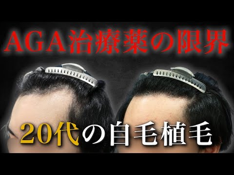 【20代植毛】AGA治療薬を内服するも、どんどん後退する生え際…