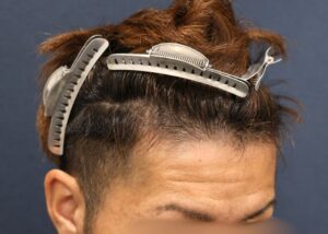 施術前