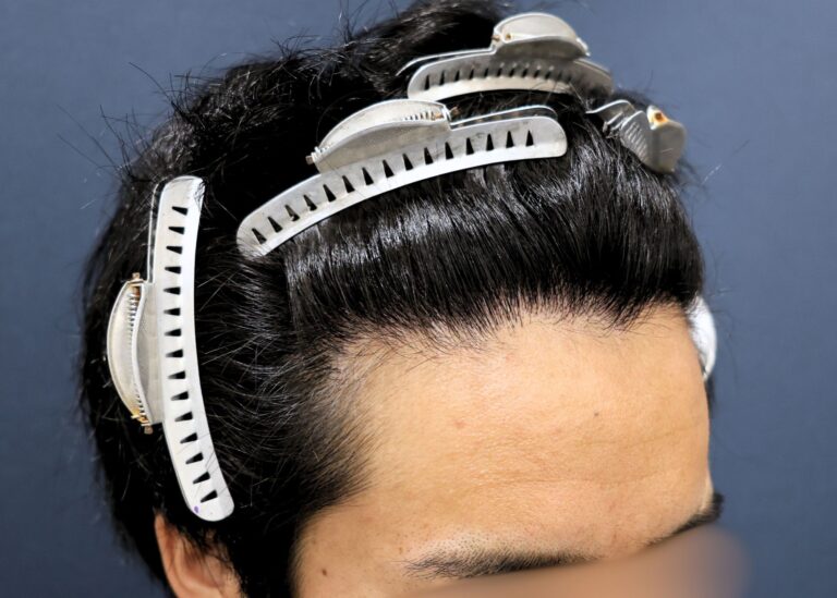 症例写真