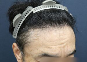施術後6ヶ月