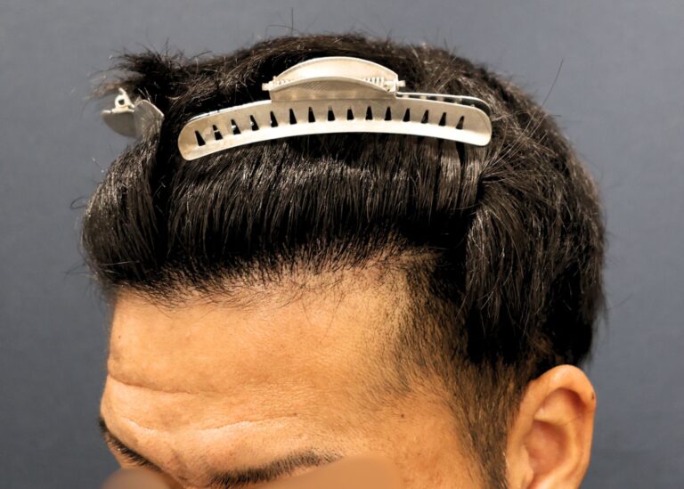 症例写真