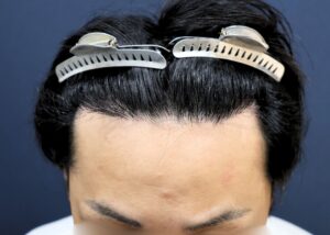施術後6ヶ月