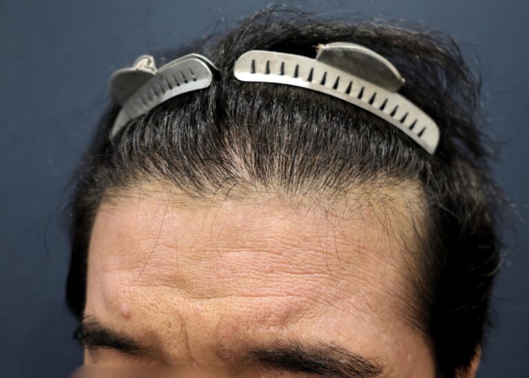 症例写真