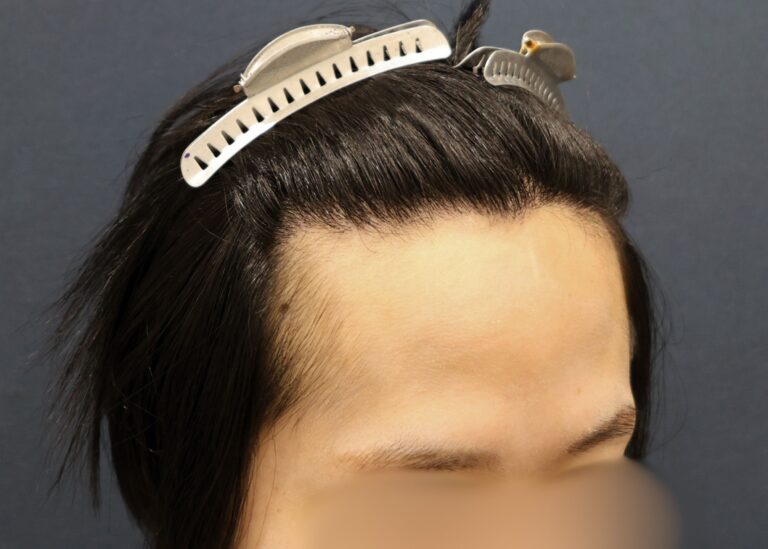 症例写真