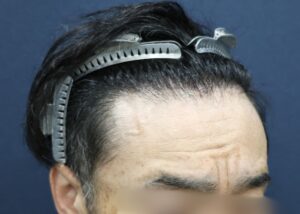 施術前