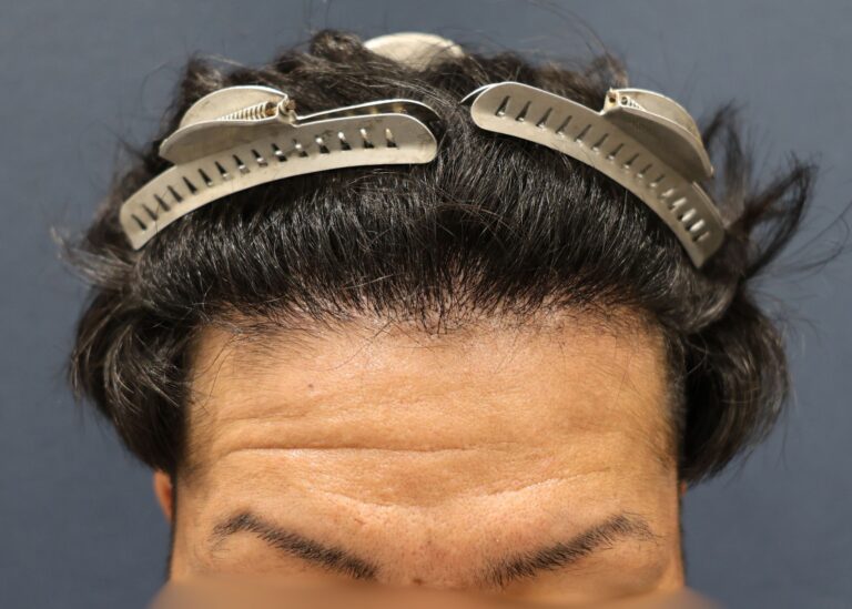症例写真