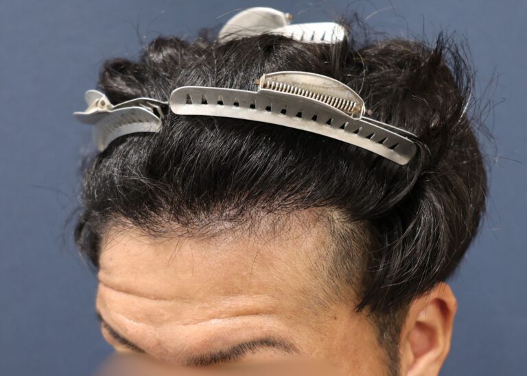 症例写真