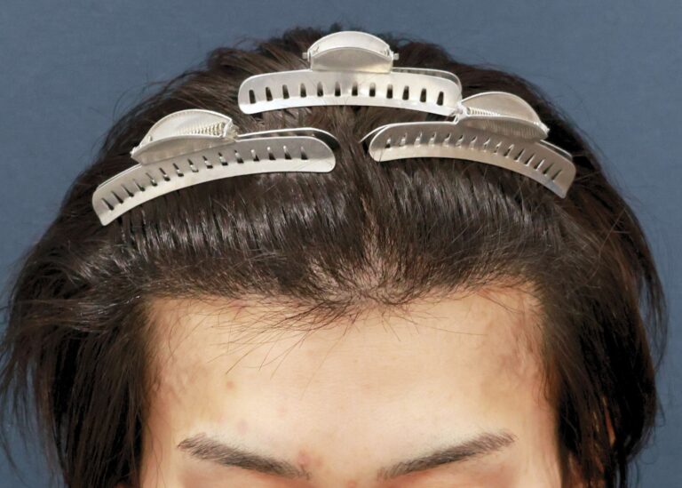 症例写真