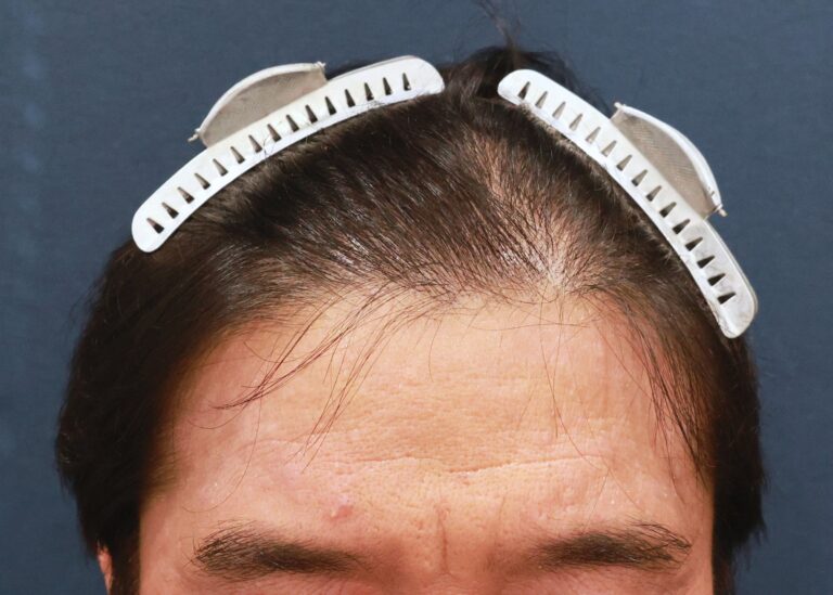 症例写真