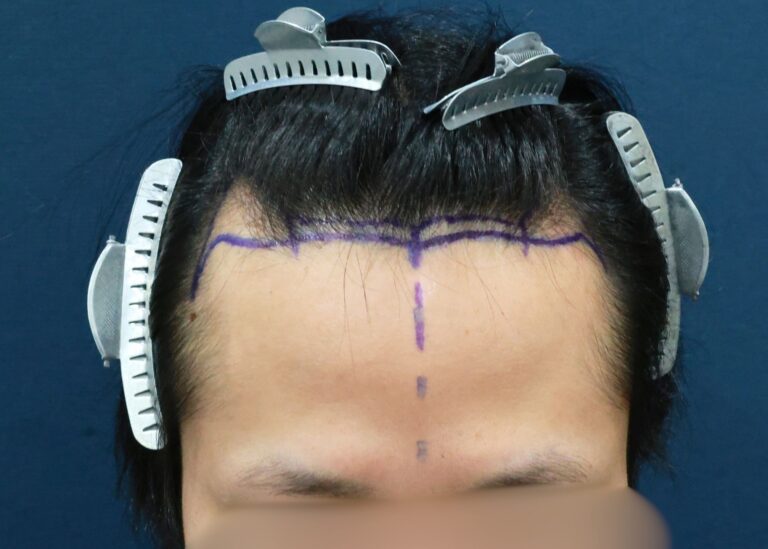 症例写真
