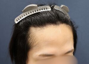 施術後6ヶ月