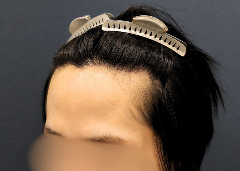症例写真
