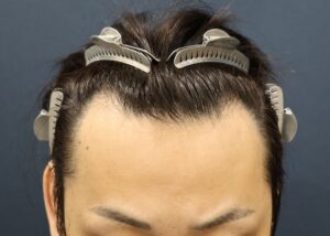 施術前