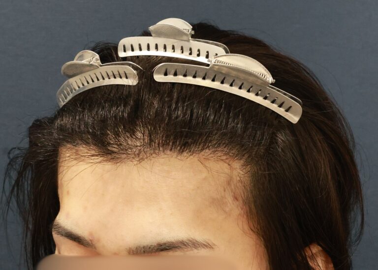症例写真