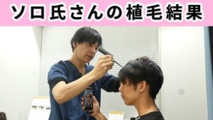 【結果発表】インフルエンサーのソロ氏さんの植毛の結果を発表します！