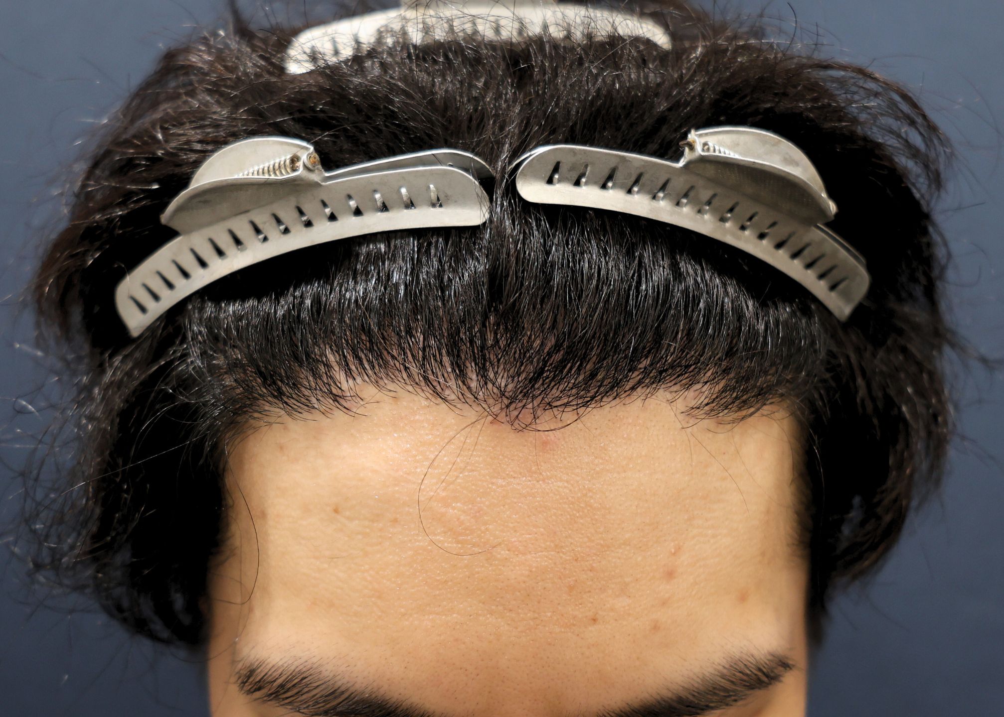 【2回目】術後6ヶ月