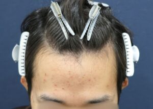 施術前