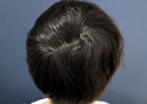 術後1年