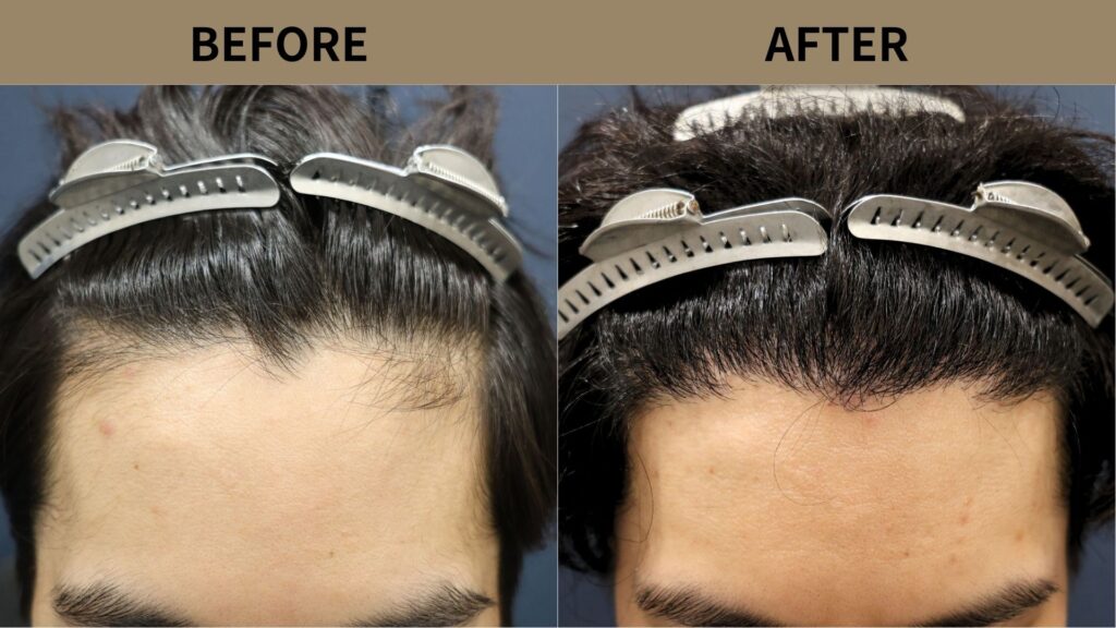 【症例更新】20代男性｜お悩み：生え際の薄毛・当院2回目