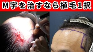 【必見】生え際やM字のコンプレックスを効果的に治します！